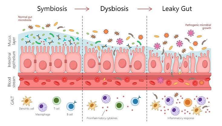 How leaky gut puts your whole health at risk slowly but steadily