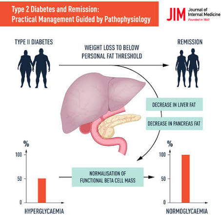 how excess calorie intake can lead to liver fat, increased glucose production, pancreatic fat accumulation, beta-cell dysfunction, and progression to Type 2 diabetes