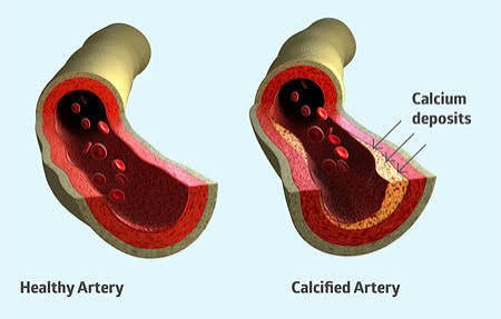 Arterial Calcification