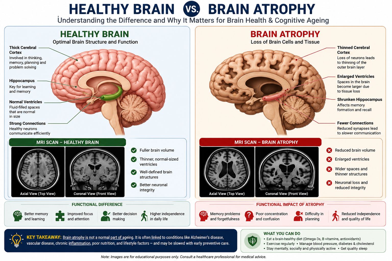 Normal Brain vs Atrophy Brain