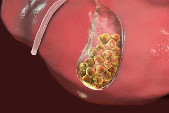 Gallstones formation
