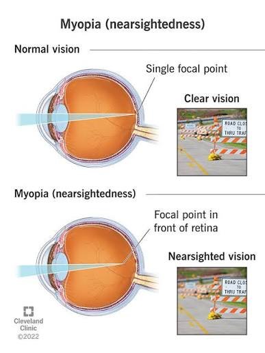 MYOPIA