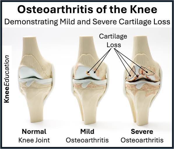 Osteoarthritis development in Indians